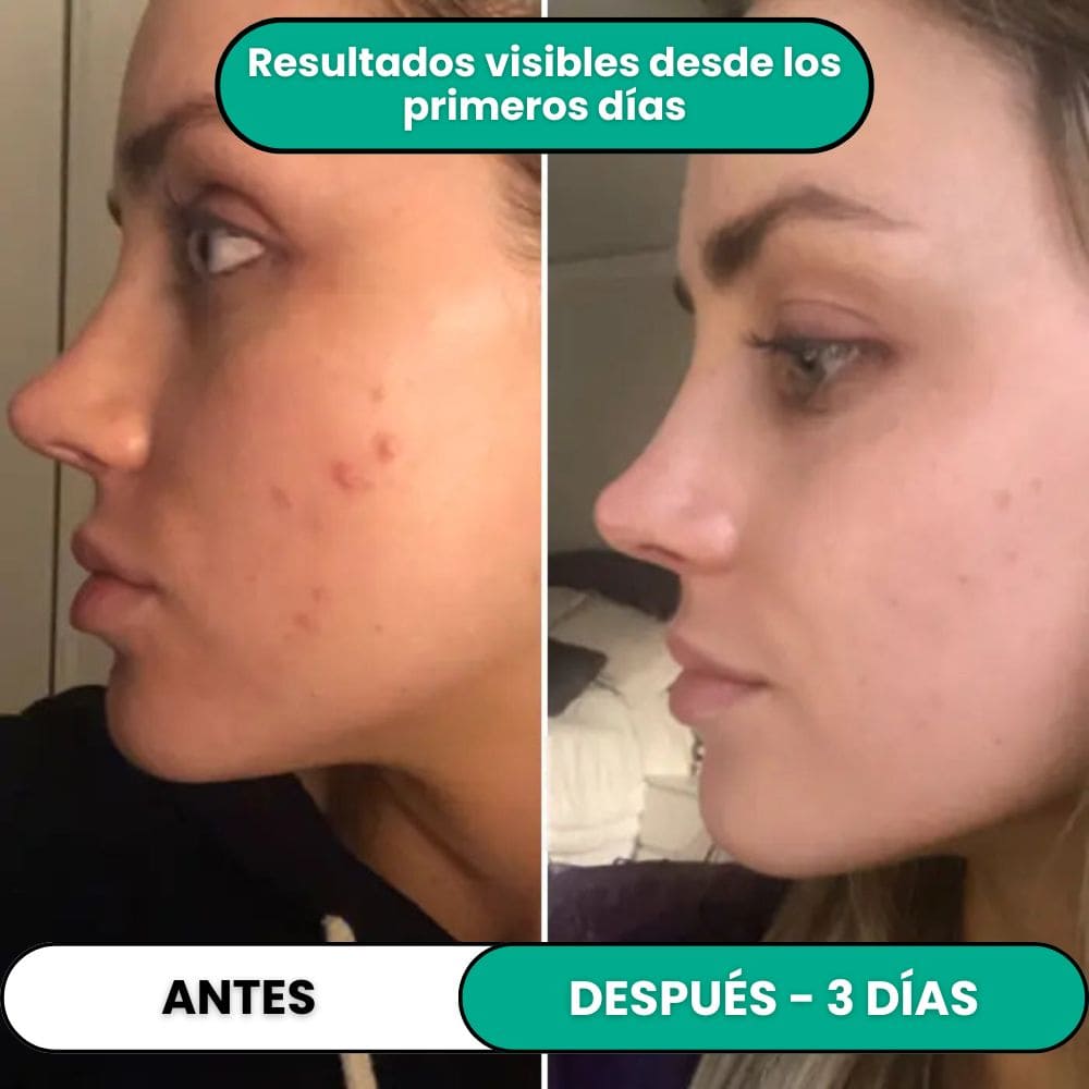 Tratamiento de Alta Frecuencia Antiimperfecciones®