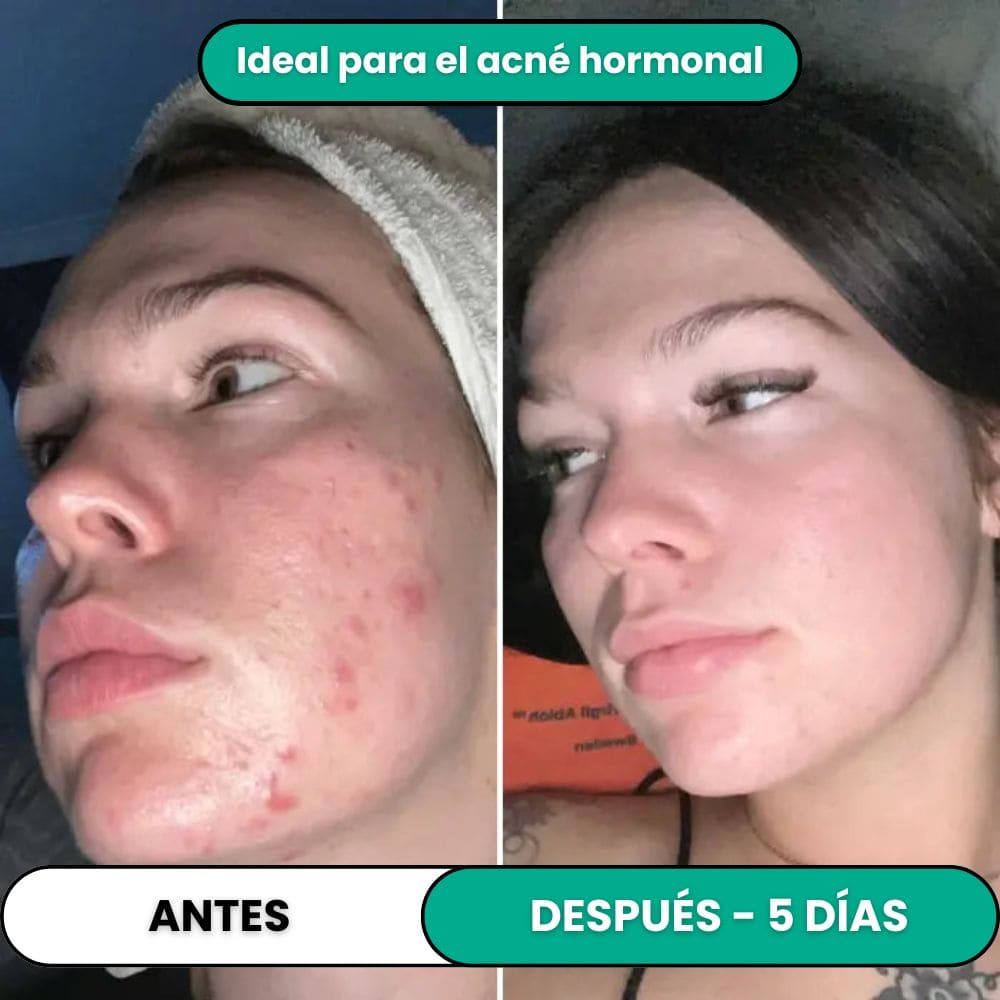 Tratamiento de Alta Frecuencia Antiimperfecciones®