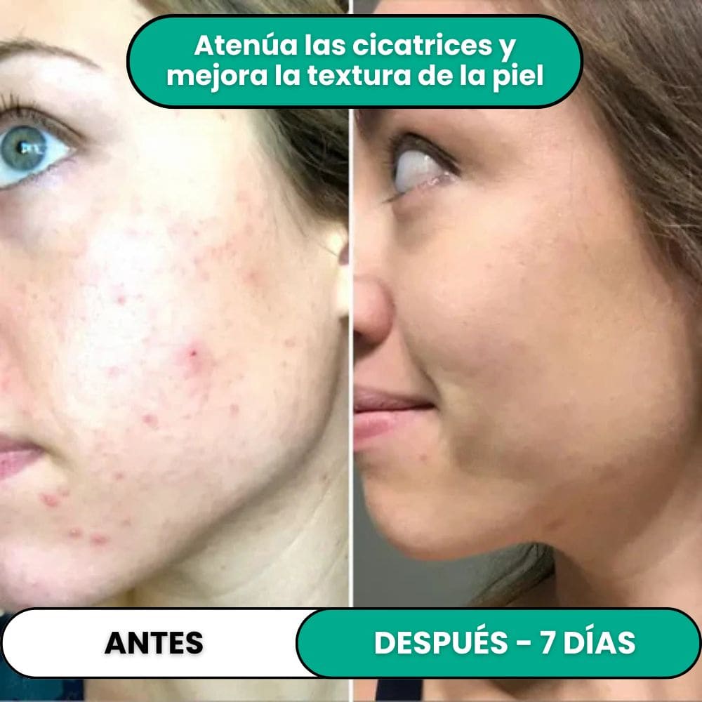 Tratamiento de Alta Frecuencia Antiimperfecciones®
