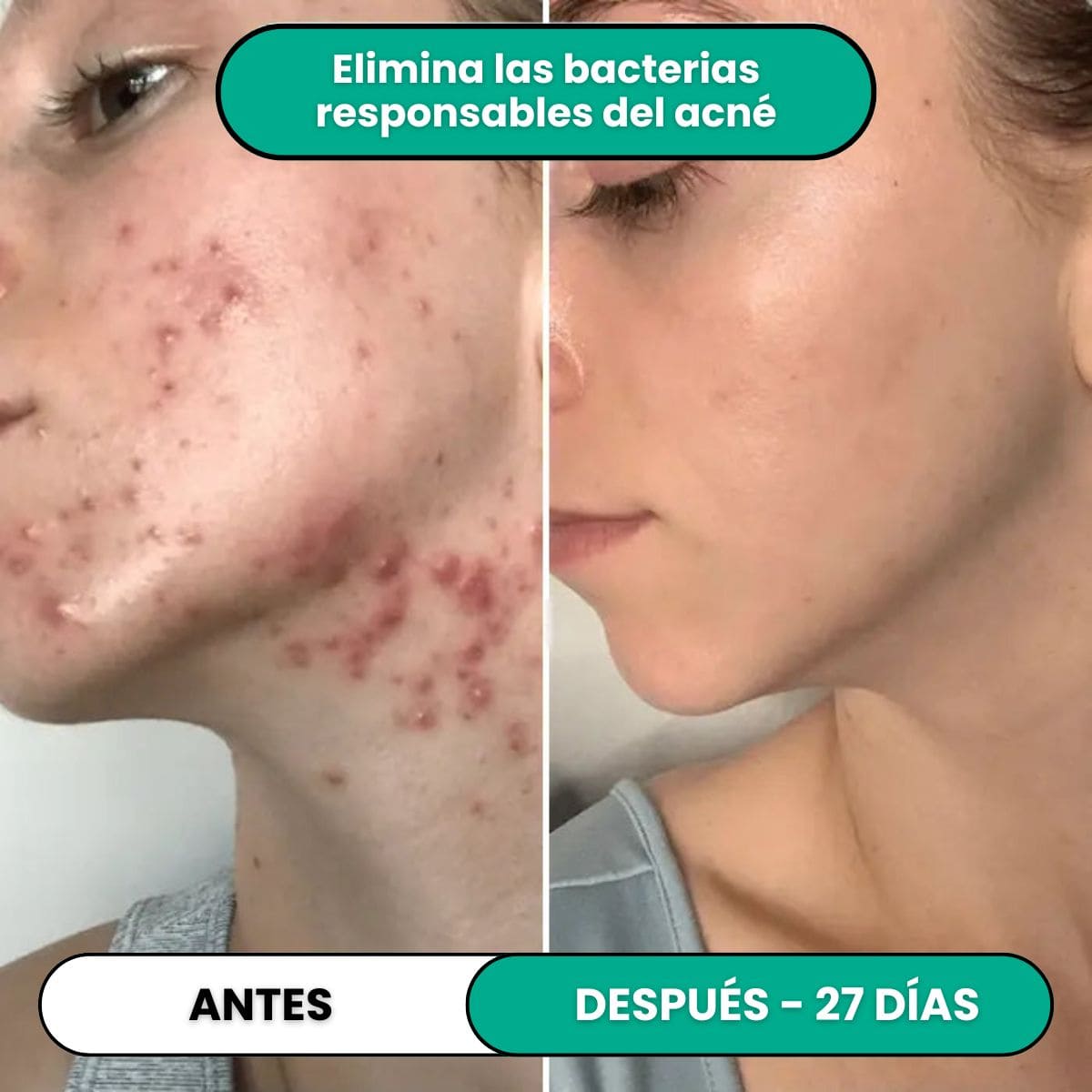 Tratamiento de Alta Frecuencia Antiimperfecciones®